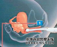 取卵详细过程图解